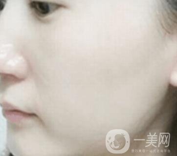 南通大學(xué)附屬醫(yī)院整形科價格表，附激光去疤案例