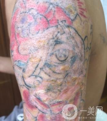 徐州市中心醫(yī)院整形科價(jià)格表，附洗紋身案例