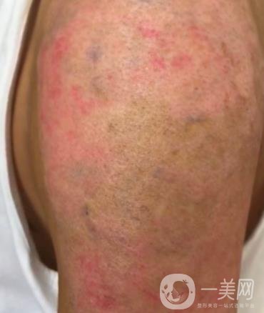 徐州市中心醫(yī)院整形科價(jià)格表，附洗紋身案例