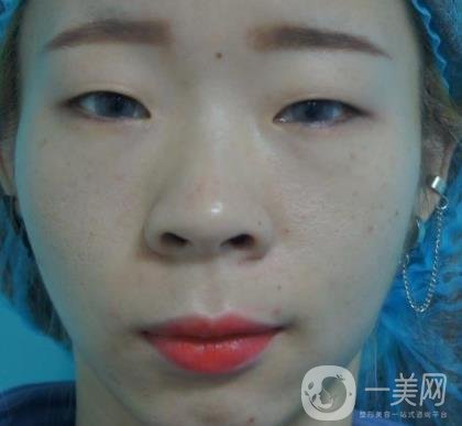 北京彤美醫(yī)療整形醫(yī)院價(jià)格表，附桂行軍雙眼皮術(shù)后*果一覽