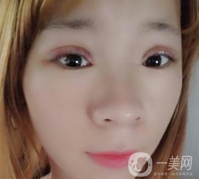 北京彤美醫(yī)療整形醫(yī)院價(jià)格表，附桂行軍雙眼皮術(shù)后*果一覽