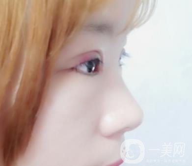 北京彤美醫(yī)療整形醫(yī)院價(jià)格表，附桂行軍雙眼皮術(shù)后*果一覽