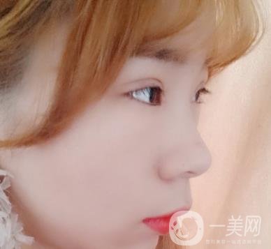 北京彤美醫(yī)療整形醫(yī)院價(jià)格表，附桂行軍雙眼皮術(shù)后*果一覽