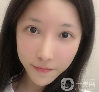 成都華美醫(yī)院做眉毛怎么樣?真實(shí)*果圖和價(jià)格一覽表展示