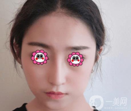 北京圣嘉榮整形價(jià)格表，內(nèi)附黃大勇整形醫(yī)生顴骨內(nèi)推案例*果圖展示