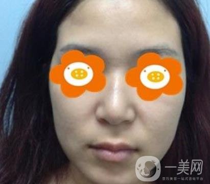 長沙貝美醫(yī)院做鼻子怎么樣?一覽價(jià)格表費(fèi)用詳情