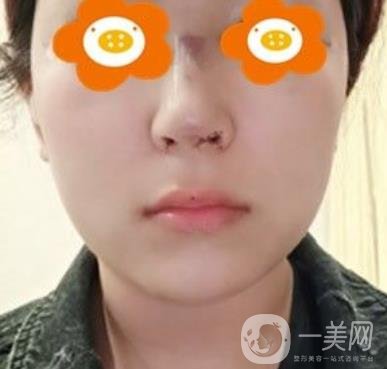 長沙貝美醫(yī)院做鼻子怎么樣?一覽價(jià)格表費(fèi)用詳情