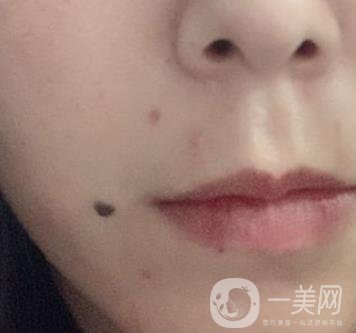 重慶附一院整形科價(jià)格表2020年公布，附祛痣整形日記