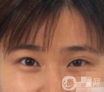 北京韓勛雙眼皮修復(fù)怎么樣？附整形價(jià)格表一覽