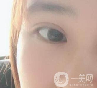 北京韓勛雙眼皮修復(fù)怎么樣？附整形價格表一覽