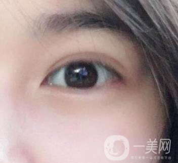 北京韓勛雙眼皮修復(fù)怎么樣？附整形價格表一覽