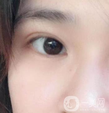 北京韓勛雙眼皮修復(fù)怎么樣？附整形價格表一覽