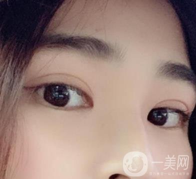 北京韓勛雙眼皮修復(fù)怎么樣？附整形價格表一覽