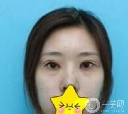 濟(jì)寧附屬醫(yī)院做雙眼皮多少錢？附真實(shí)案例及整形價(jià)格表