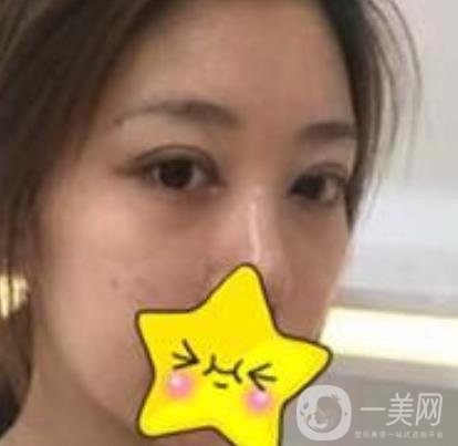 濟(jì)寧附屬醫(yī)院做雙眼皮多少錢？附真實(shí)案例及整形價(jià)格表