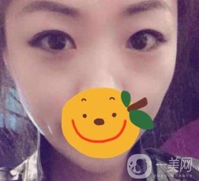昆明市第一人民醫(yī)院雙眼皮多少錢？附案例及2020全新整形價格表