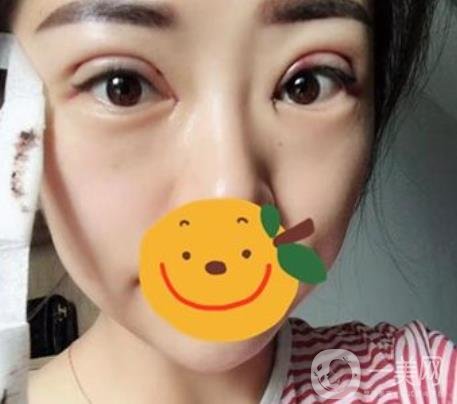 昆明市第一人民醫(yī)院雙眼皮多少錢？附案例及2020全新整形價格表
