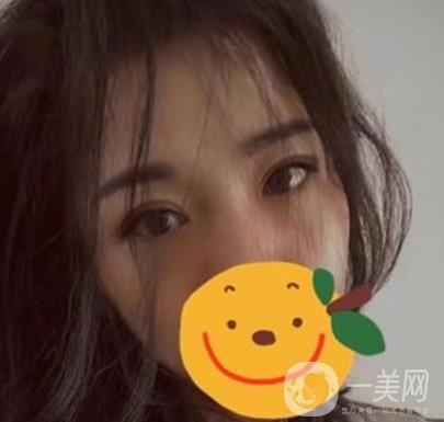 昆明市第一人民醫(yī)院雙眼皮多少錢？附案例及2020全新整形價格表