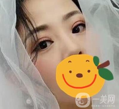 昆明市第一人民醫(yī)院雙眼皮多少錢？附案例及2020全新整形價格表