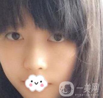 劉波醫(yī)生隆鼻修復