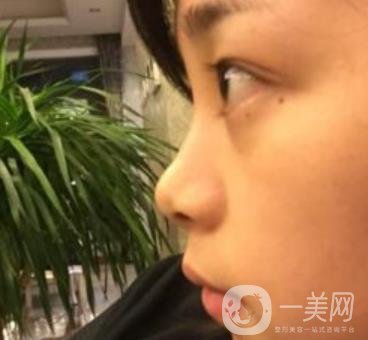 上海王輝醫(yī)生隆鼻