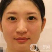 武漢禾麗趙星星隆鼻怎么樣？附鼻部整形價(jià)格一覽