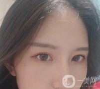 北京處布仁醫(yī)生隆鼻案例，看整形價(jià)格及果怎么樣