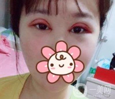 上海華美楊亞益做眼睛多少錢？?jī)r(jià)格表及案例詳情