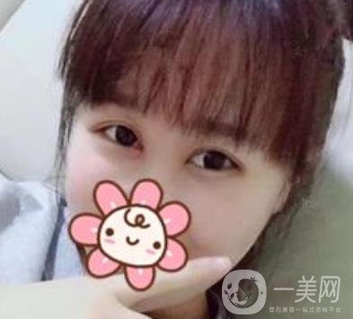 上海華美楊亞益做眼睛多少錢？?jī)r(jià)格表及案例詳情
