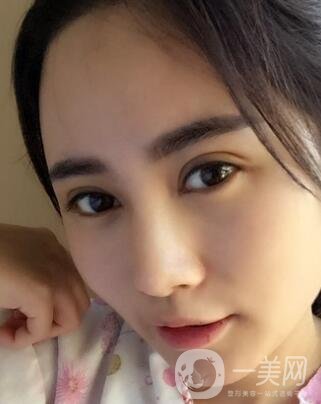 北京處整形外科價(jià)格(目)表2020一覽，附雙眼皮案例