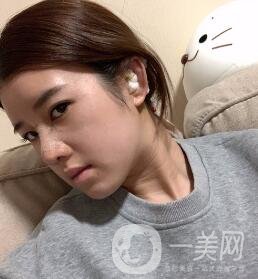 鹽城東方女子整形醫(yī)院價(jià)格表明細(xì)，附隆鼻案例