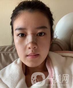 鹽城東方女子整形醫(yī)院價(jià)格表明細(xì)，附隆鼻案例