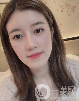 鹽城東方女子整形醫(yī)院價(jià)格表明細(xì)，附隆鼻案例