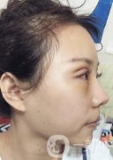 蘭大二院整形外科價(jià)格表2020，附雙眼皮整形日記