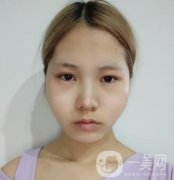 運(yùn)城中心醫(yī)院整形外科價(jià)格表，附顴骨降低案例分享