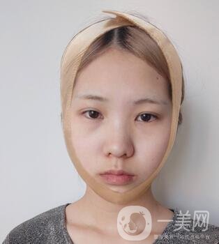 運城中心醫(yī)院整形外科價格表，附顴骨降低案例分享