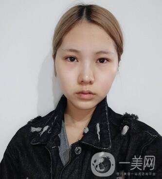 運城中心醫(yī)院整形外科價格表，附顴骨降低案例分享