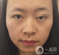 河南省立眼科醫(yī)院做上臉下垂怎么樣?價(jià)格表和真人果圖展示