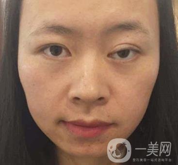 河南省立眼科醫(yī)院做上臉下垂怎么樣?價格表和真人*果圖展示