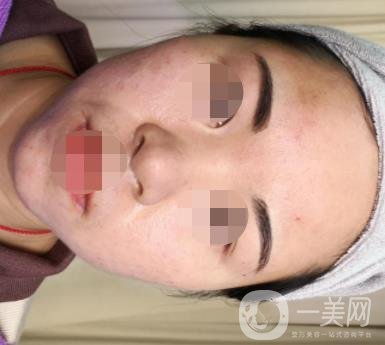 北京醫(yī)院整形科繡眉*果怎么樣?2020年價格表日常收費詳情一覽