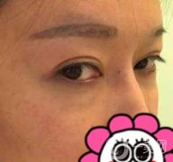 北京友誼醫(yī)院整形科祛眼袋果好不好？2020年價(jià)格價(jià)目收費(fèi)曝光啦