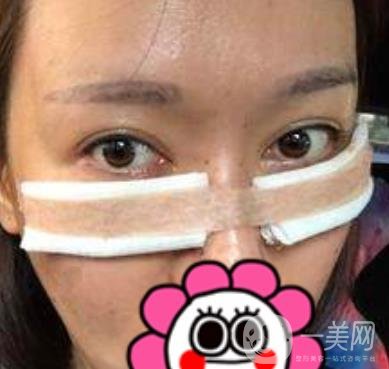 北京友誼醫(yī)院整形科祛眼袋*果好不好？2020年價(jià)格價(jià)目收費(fèi)曝光啦