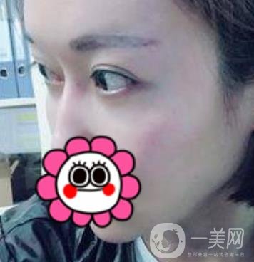 北京友誼醫(yī)院整形科祛眼袋*果好不好？2020年價(jià)格價(jià)目收費(fèi)曝光啦