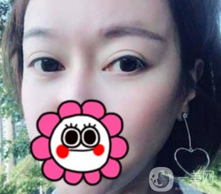 北京友誼醫(yī)院整形科祛眼袋*果好不好？2020年價(jià)格價(jià)目收費(fèi)曝光啦