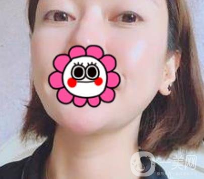 北京友誼醫(yī)院整形科祛眼袋*果好不好？2020年價(jià)格價(jià)目收費(fèi)曝光啦
