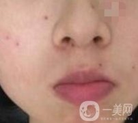 青醫(yī)附院激光去痣多少錢(qián)？案例及整形價(jià)格表分享