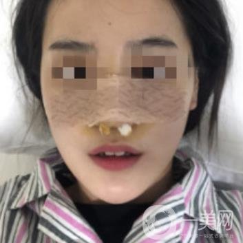 深圳人民醫(yī)院整形外科價(jià)目表，附隆鼻案例