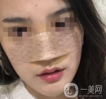 深圳人民醫(yī)院整形外科價(jià)目表，附隆鼻案例