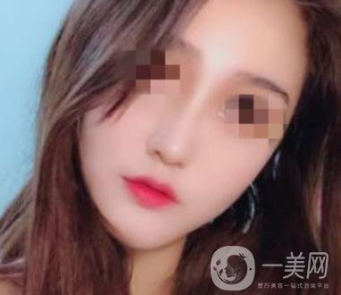 深圳人民醫(yī)院整形外科價(jià)目表，附隆鼻案例