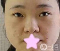 寶雞人民醫(yī)院美容科價(jià)格表及*前后恢復(fù)圖